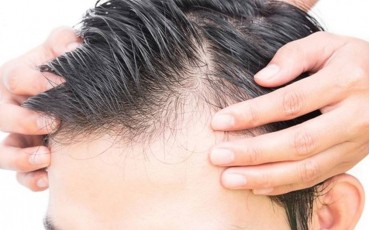 The Evolution of Hair Regrowth Therapy